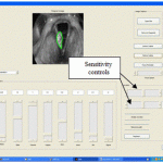Figure 3 The interactive interface highlighting the tumor to be ablated